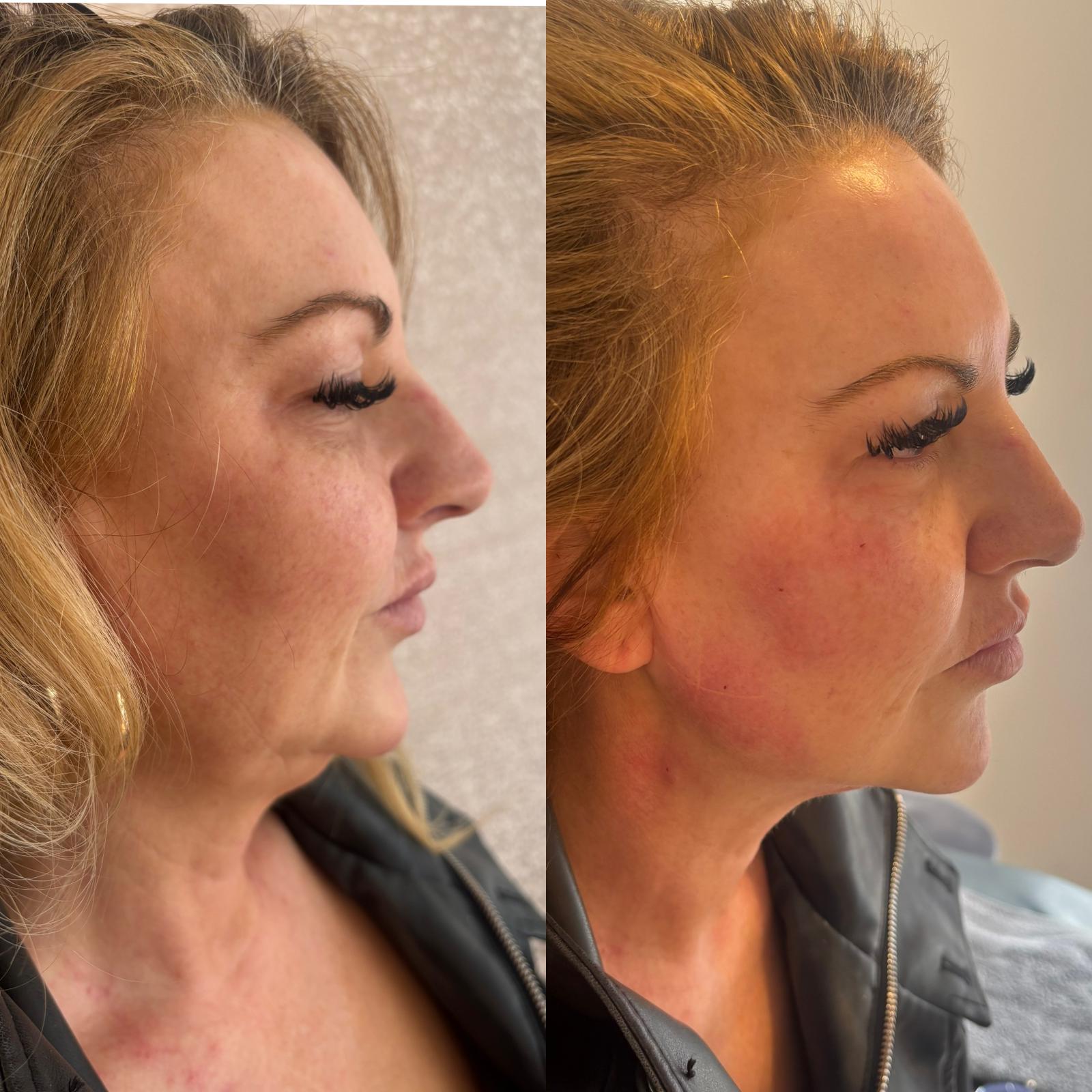 Jawline & Neck — before and after Endolift