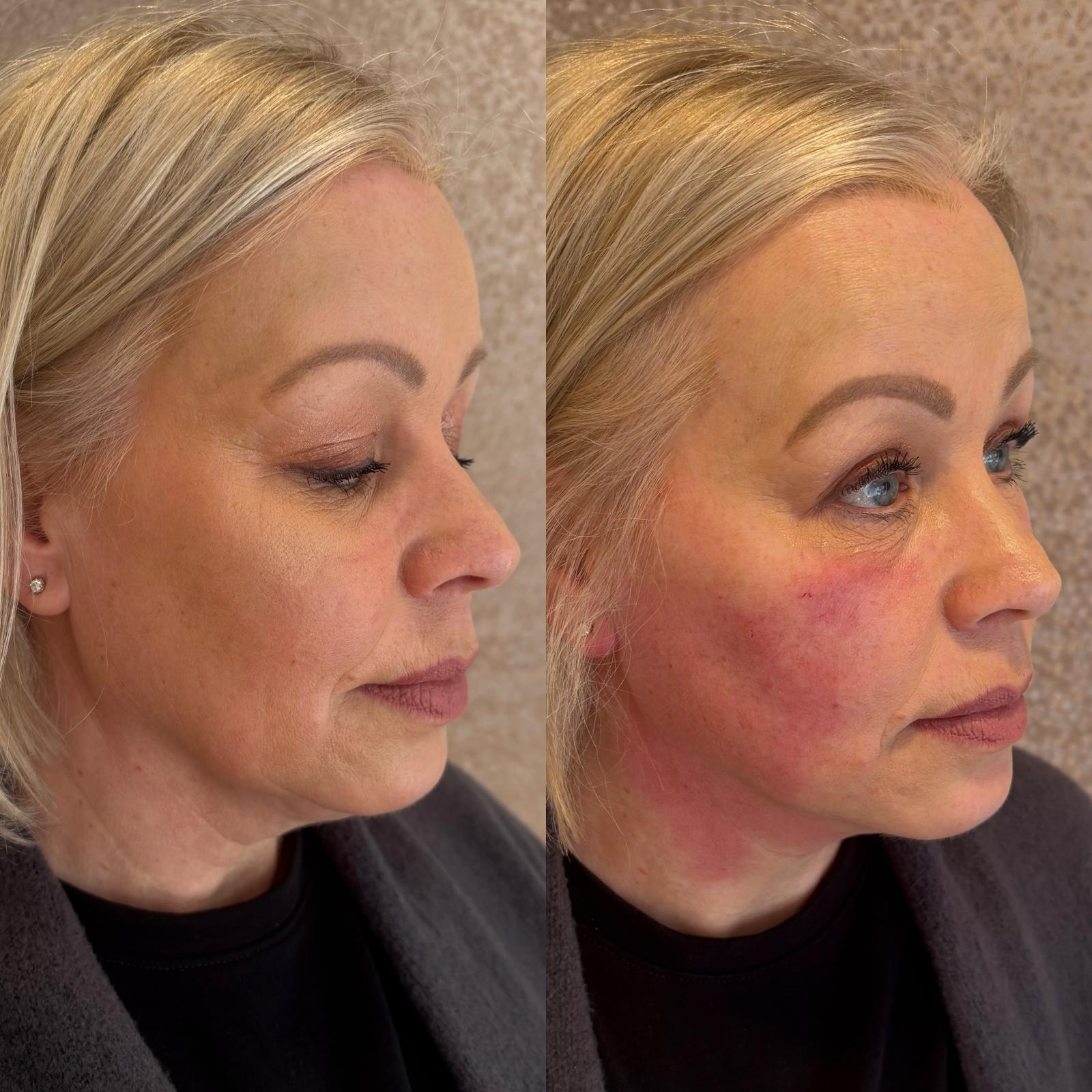 Full Face Lift — before and after Endolift