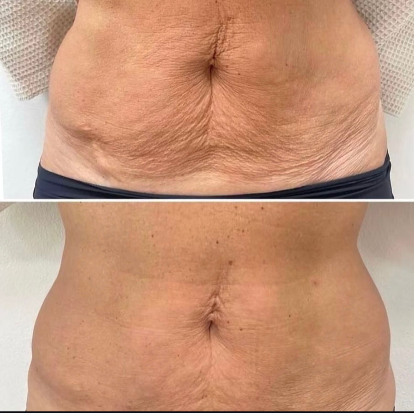 Tummy Tightening — before and after Endolift